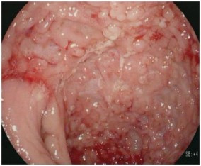 Crohns