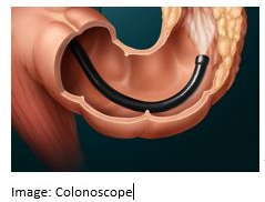 Crohns