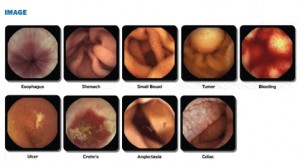 Capsul Endoscopy