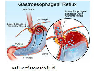 Reflux